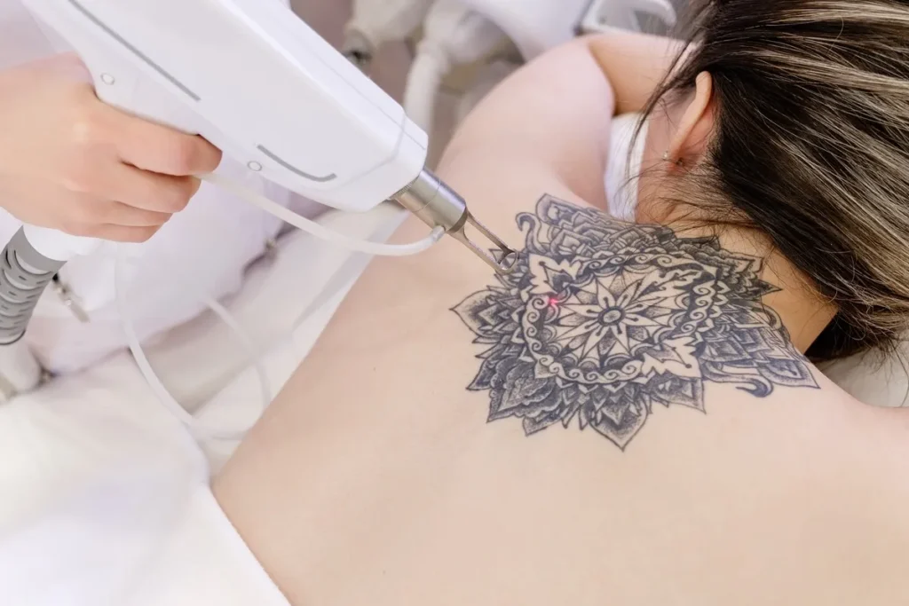 Laser Tattoo Removal In Anchorage, AK | Safe Ink Removal