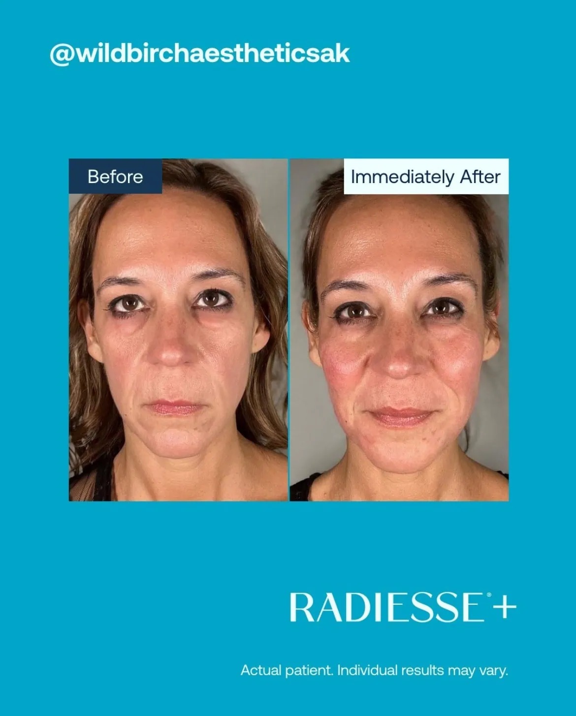 Before and After Radiesse Treatment h | Med Spa Consultation In Anchorage, AK | SkinLife MedSpa