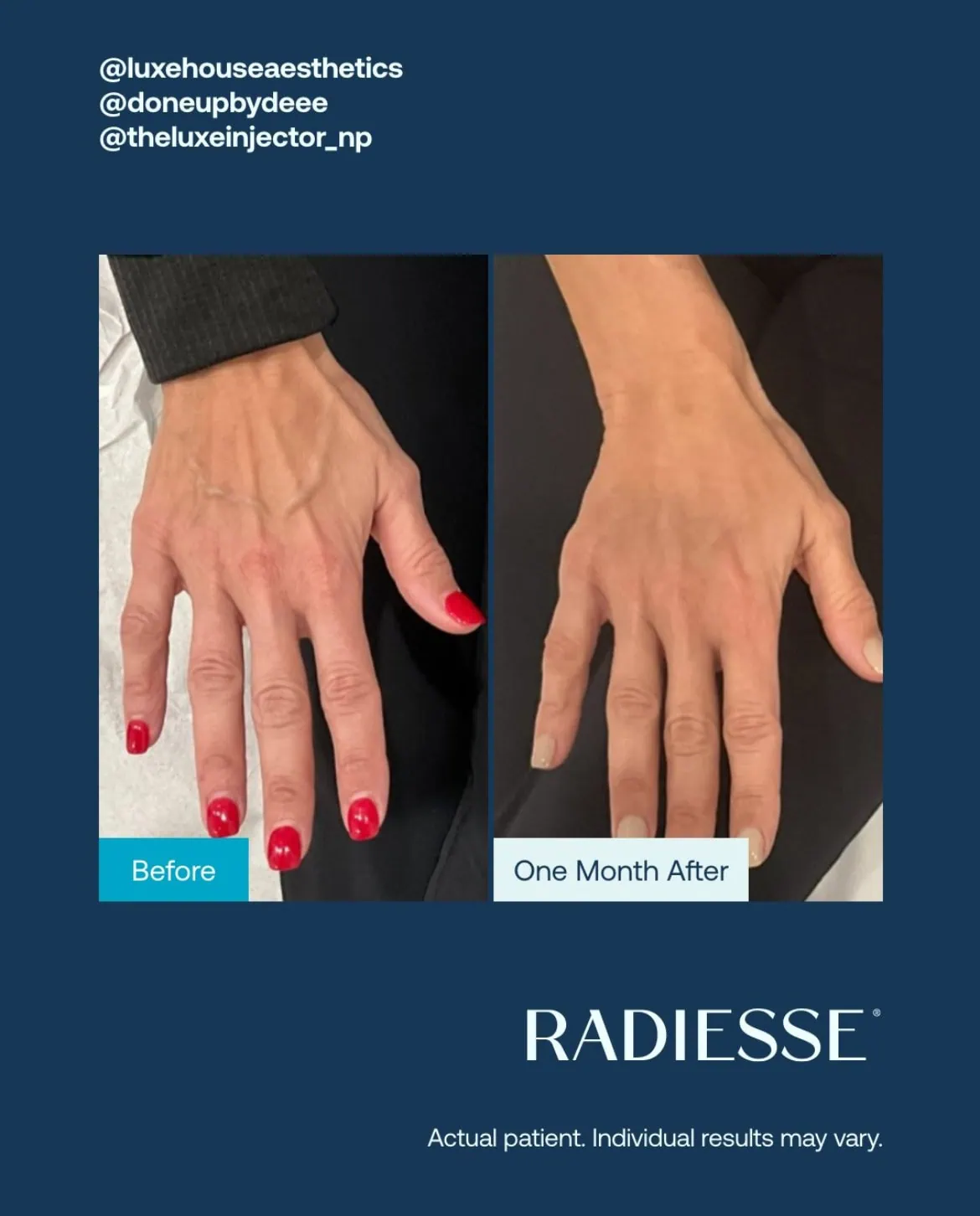 Before and After Radiesse Treatment h | Med Spa Consultation In Anchorage, AK | SkinLife MedSpa