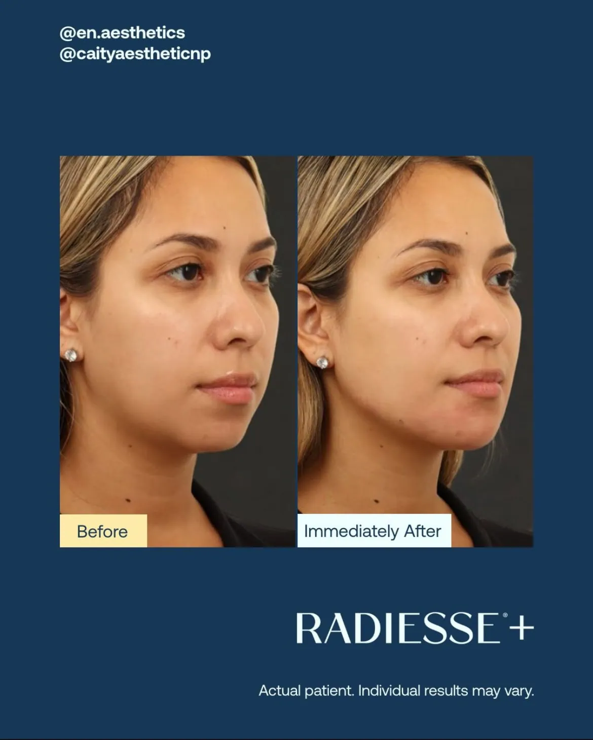 Before and After Radiesse Treatment h | Med Spa Consultation In Anchorage, AK | SkinLife MedSpa