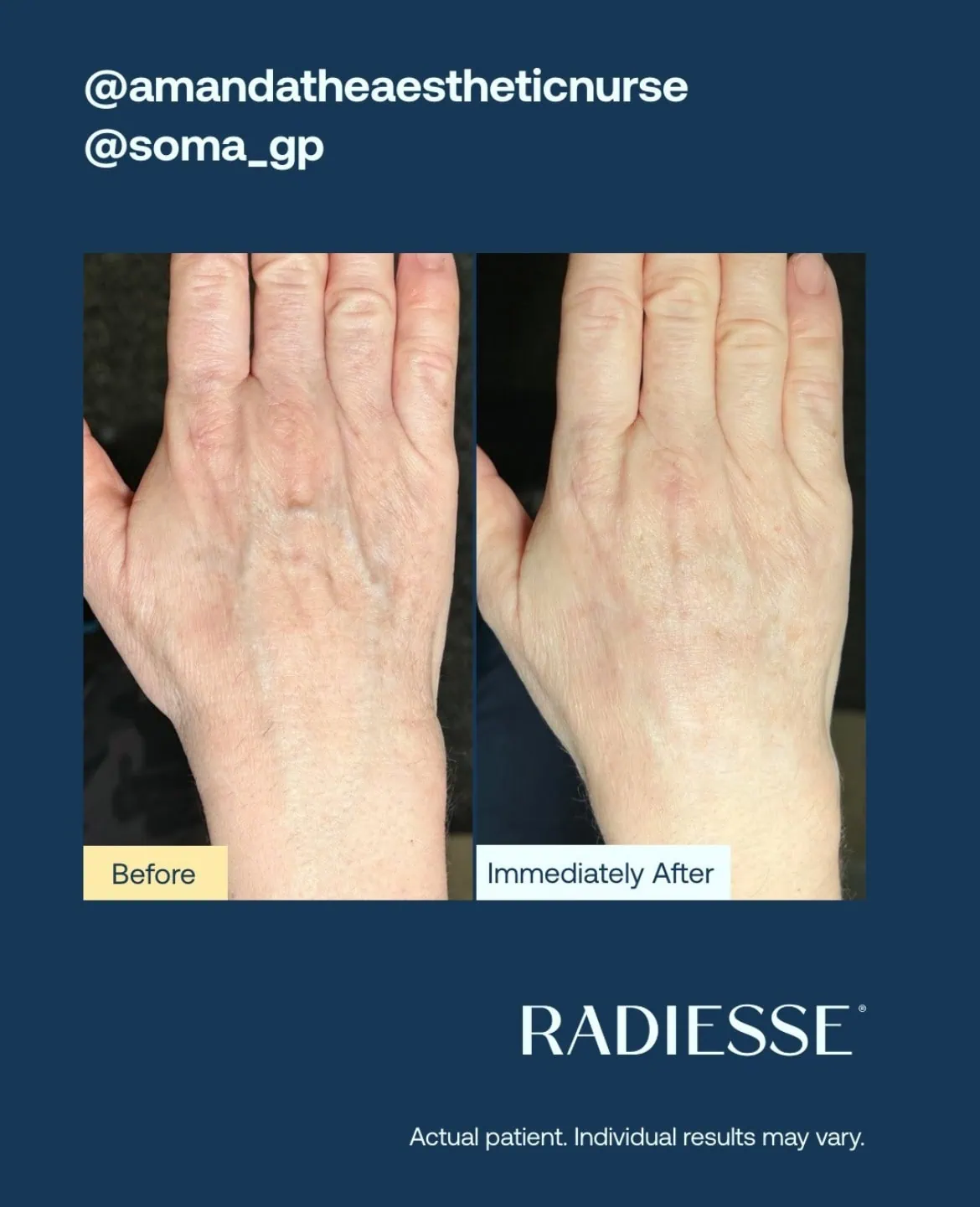 Before and After Radiesse Treatment h | Med Spa Consultation In Anchorage, AK | SkinLife MedSpa