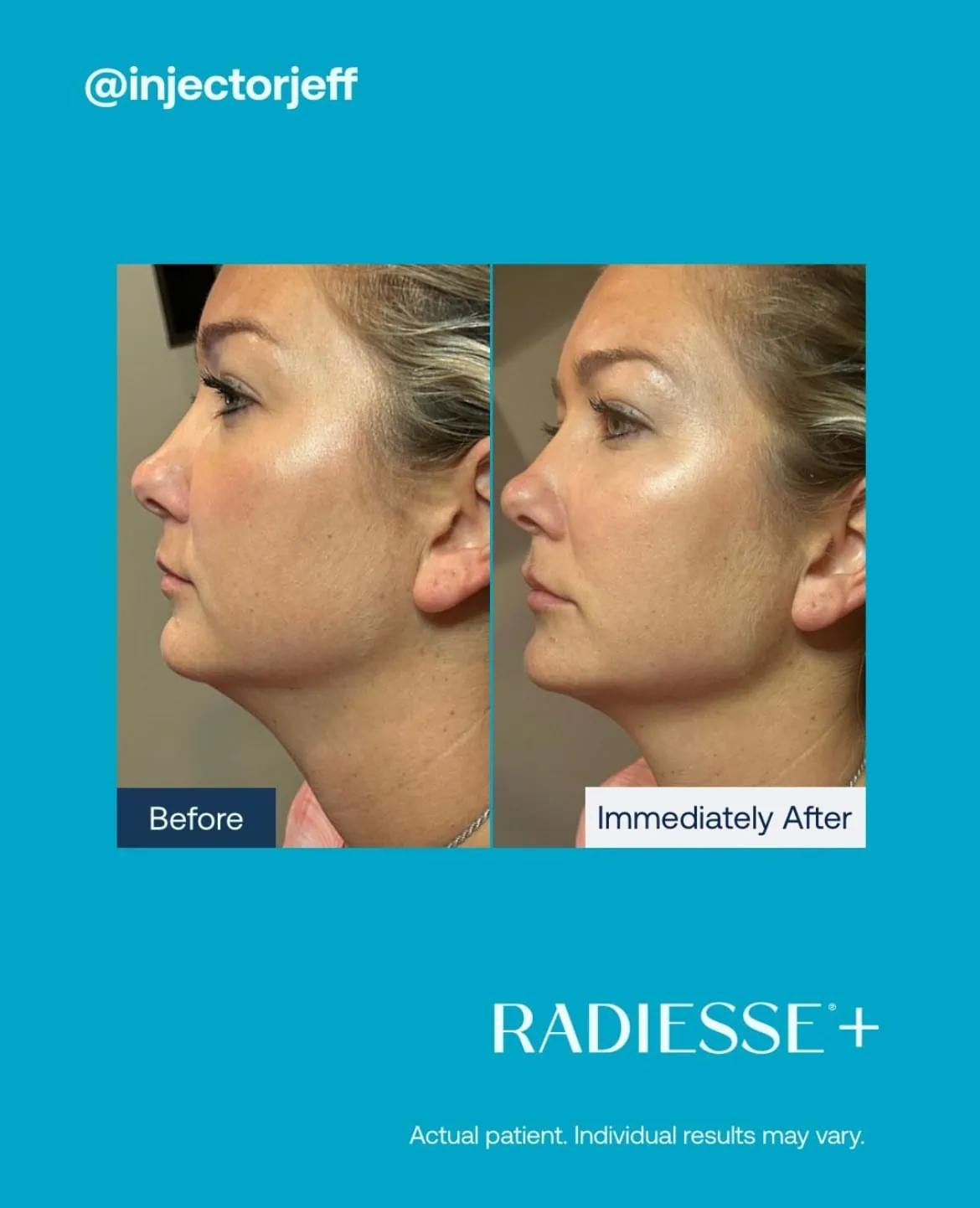 Before and After Radiesse Treatment h | Med Spa Consultation In Anchorage, AK | SkinLife MedSpa