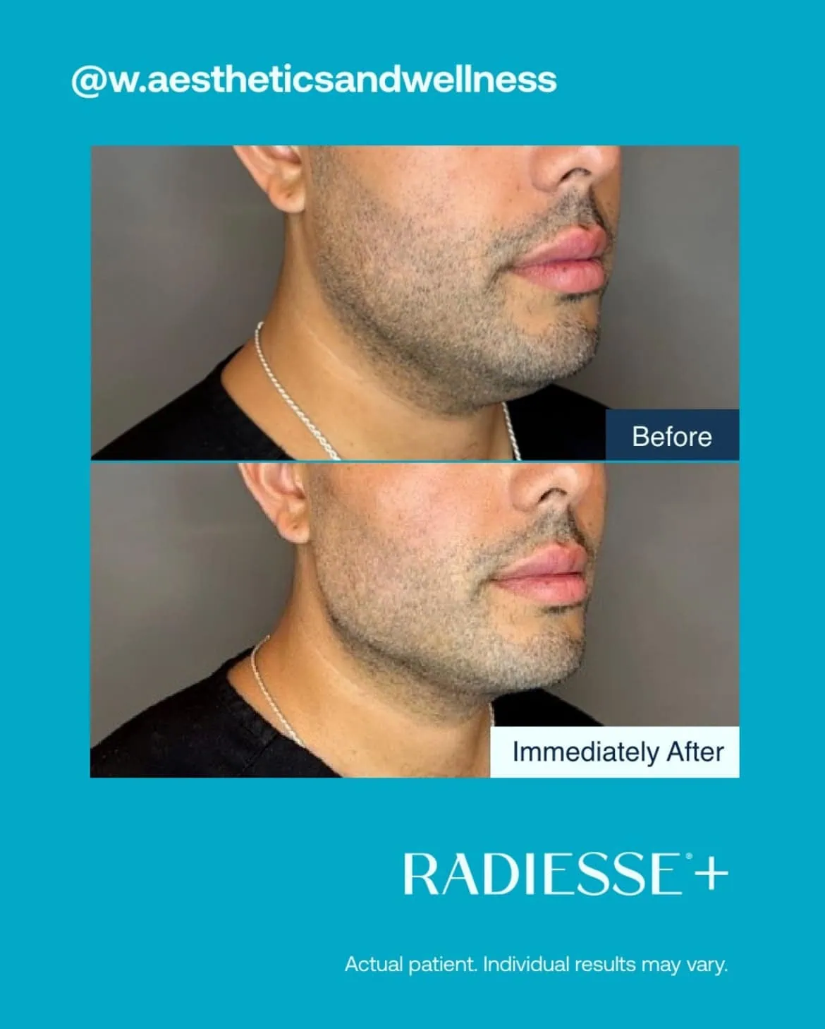 Before and After Radiesse Treatment h | Med Spa Consultation In Anchorage, AK | SkinLife MedSpa