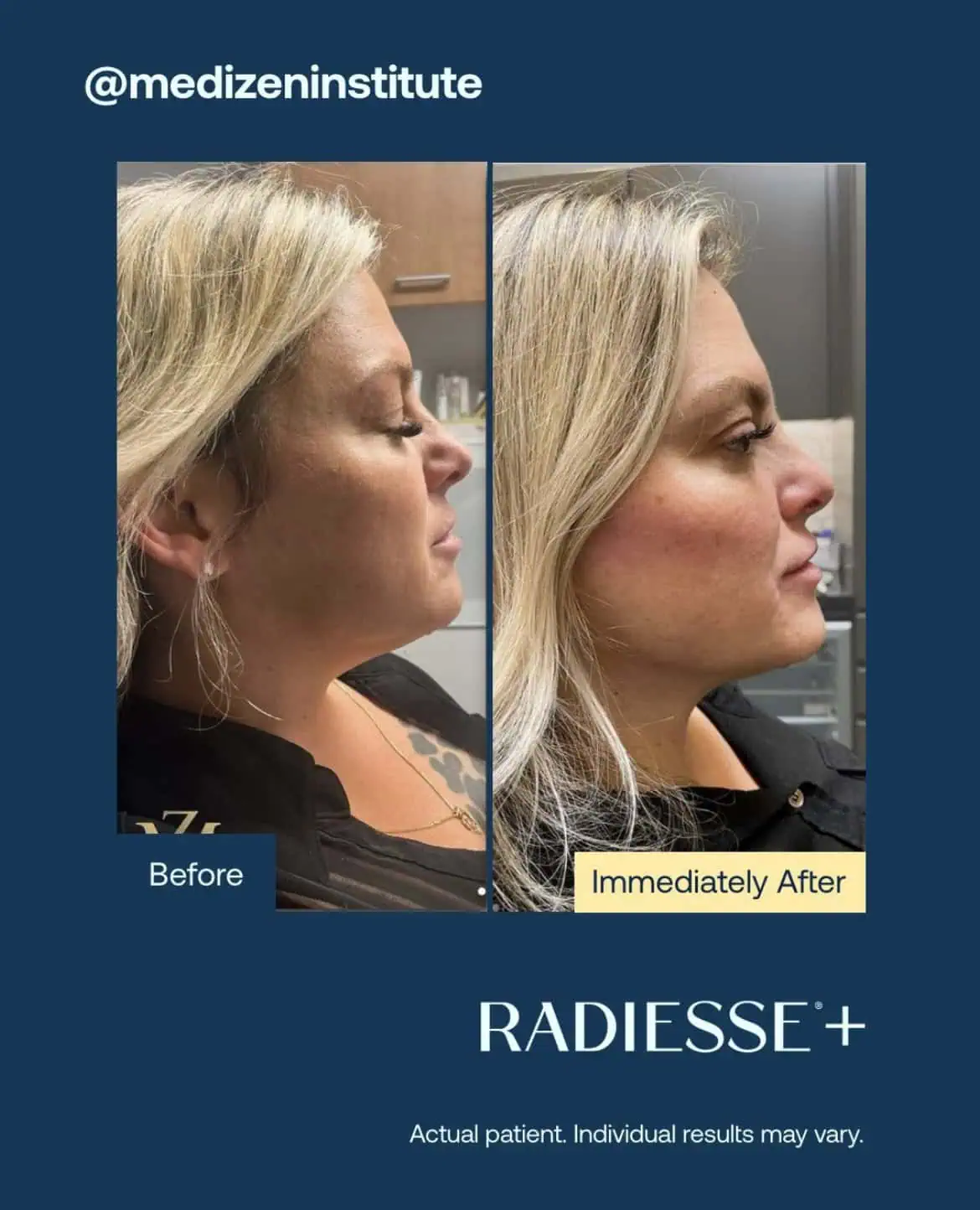 Before and After Radiesse Treatment h | Med Spa Consultation In Anchorage, AK | SkinLife MedSpa