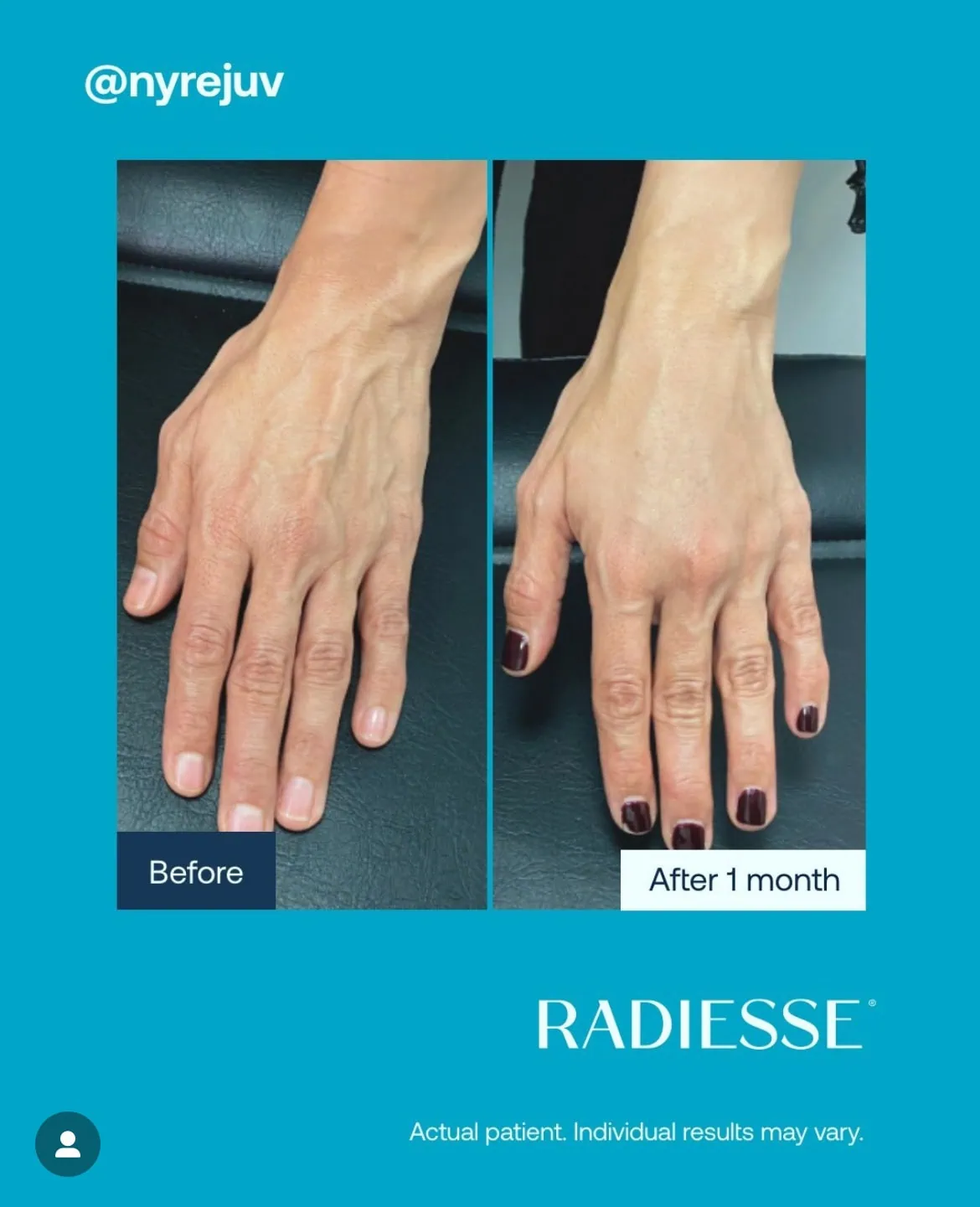Before and After Radiesse Treatment h | Med Spa Consultation In Anchorage, AK | SkinLife MedSpa