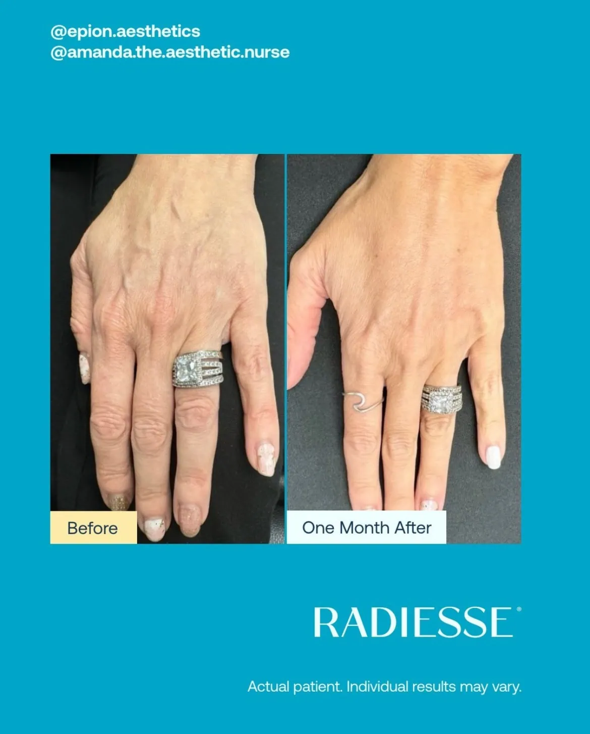 Before and After Radiesse Treatment h | Med Spa Consultation In Anchorage, AK | SkinLife MedSpa
